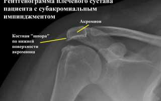 Импичмент синдром плечевого сустава что это такое