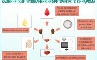 Нефротический и нефритический синдром таблица