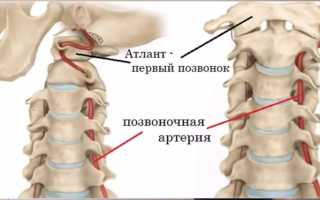 Бег при синдроме позвоночной артерии