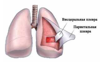 Синдром жидкости в полости плевры