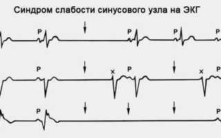 Синдром слабого синусового узла экг