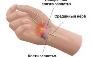 Лечение туннельного синдрома при беременности