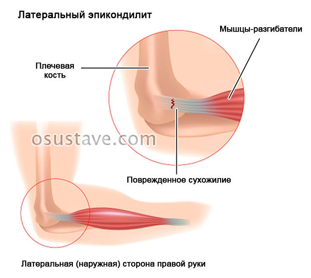 латеральный эпикондилит