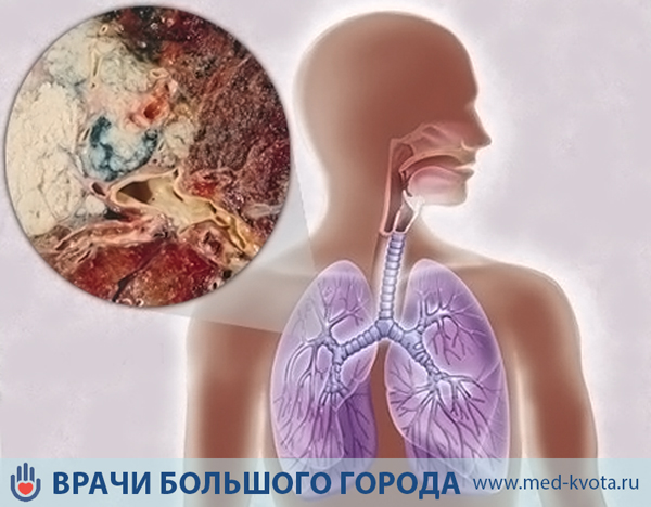 Виды рака Панкоста