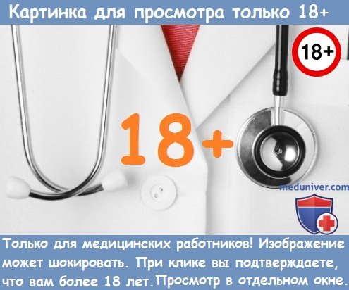 синдром гиперстимуляции яичников