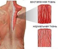 Миозит