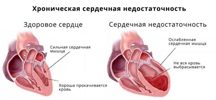 I50.0 Застойная сердечная недостаточность