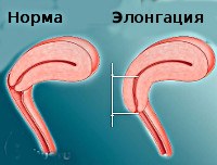 Элонгация шейки матки