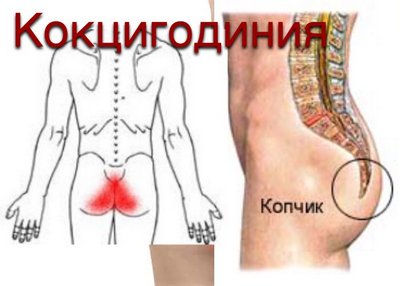 Боли при кокцигодинии