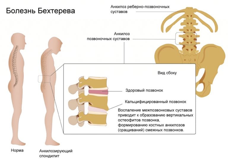 Болевой синдром в спине справа