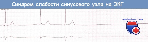 Синдром слабости синусового узла (СССУ) на ЭКГ