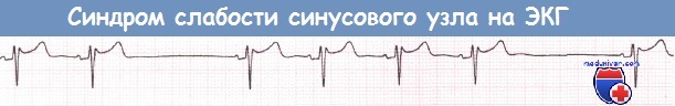 Синдром слабости синусового узла (СССУ) на ЭКГ