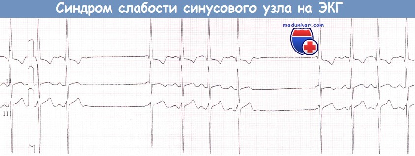 Синдром слабости синусового узла (СССУ) на ЭКГ