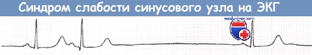 Синдром слабости синусового узла (СССУ) на ЭКГ
