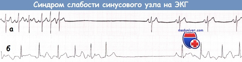 Синдром слабости синусового узла (СССУ) на ЭКГ