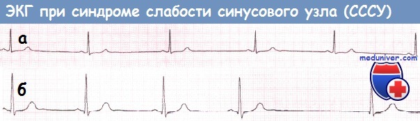 Синдром слабости синусового узла (СССУ) на ЭКГ