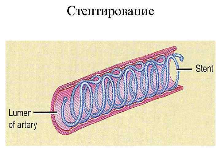 Стентирование 