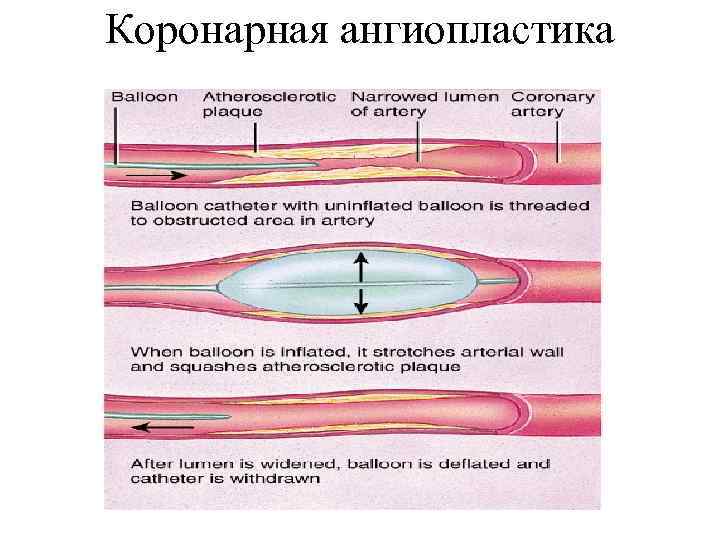 Коронарная ангиопластика 