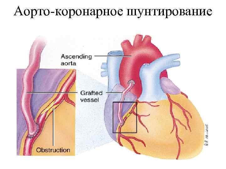Аорто-коронарное шунтирование 