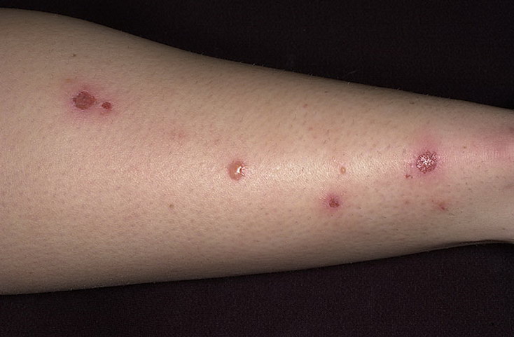 impetigo-foto-na-noge