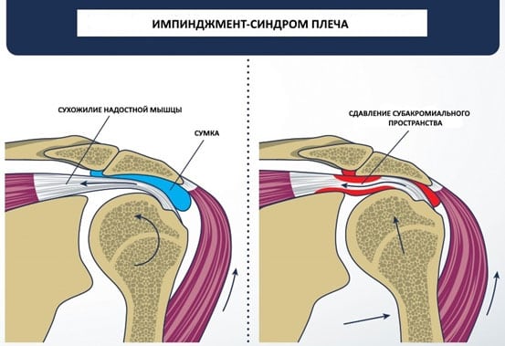 Импичмент синдром плечевого сустава что это такое