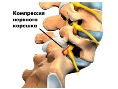 Корешковый синдром