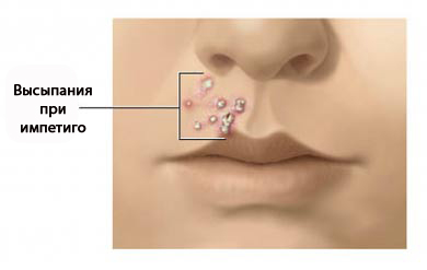 lechenie-impetigo-u-detej