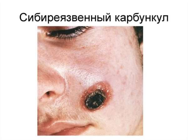 Код мкб 10 фурункул тела