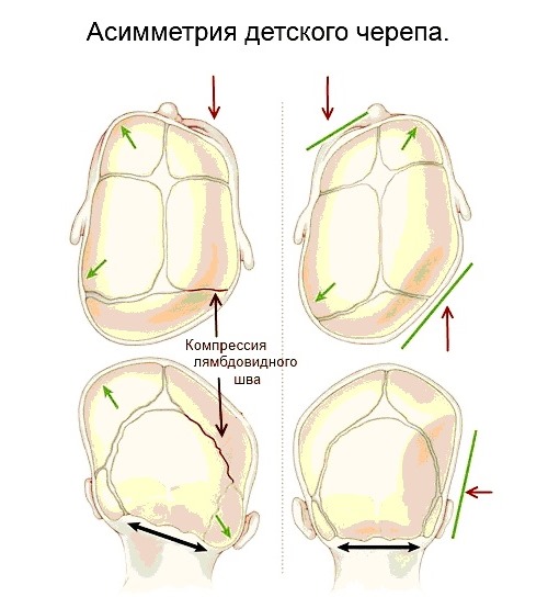 Первое последствие у младенцев при кривошеи - асимметрическое формирование черепа