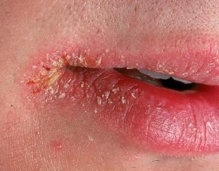schelevidnoe-impetigo-zaedy