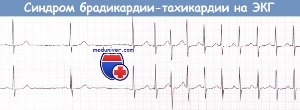 Синдром брадикардии-тахикардии на ЭКГ